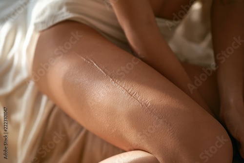 Healed surgical scars on young woman's thigh with natural skin tone