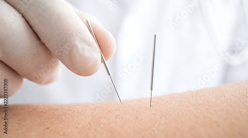 Acupuncture needles inserted into skin for alternative medical therapy with medicine treatment healthcare holistic wellness
