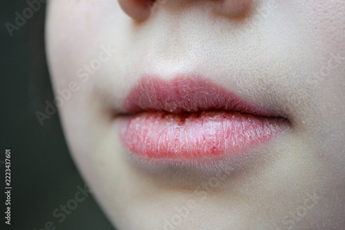 Dry and damaged lips of a girl