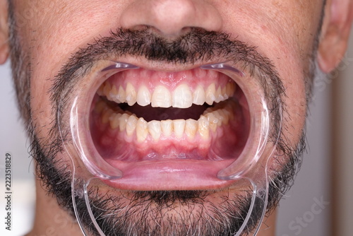 Frontal Close-Up of Teeth After Clear Aligner Treatment