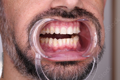 Side View of Teeth After Invisible Orthodontic Treatment