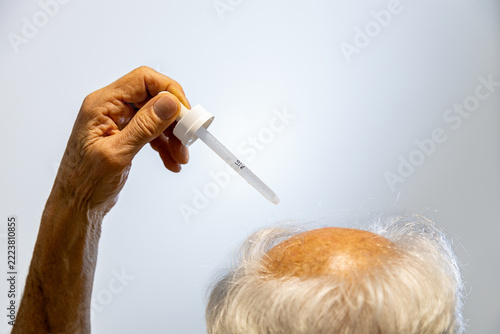 Man applying Minoxidil hair regrowth solution with a dropper to his scalp