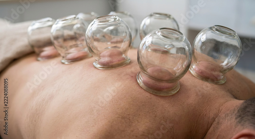 Glass Cupping on the Upper Back