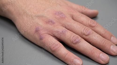 Violaceous Gottron’s Papules Over the Knuckles in Dermatomyositis