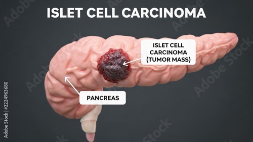 Islet cell carcinoma 3D medical illustration, labelled diagram of pancreas organ with malignant islet cell tumor mass, pancreatic neuroendocrine cancer visualization