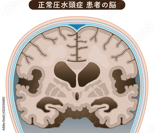 正常圧水頭症 Normal Pressure Hydrocephalus