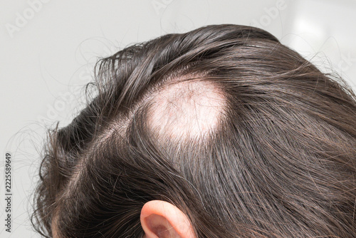 Woman with Patchy Hair Loss on Scalp, Alopecia Areata