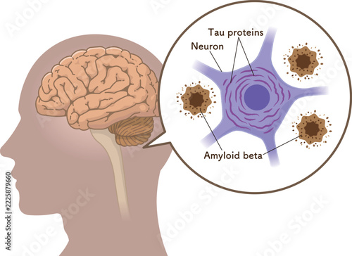 アルツハイマー病の脳　アミロイドβとタウたんぱく質The Alzheimer's Brain: Amyloid-beta & Tau Protein