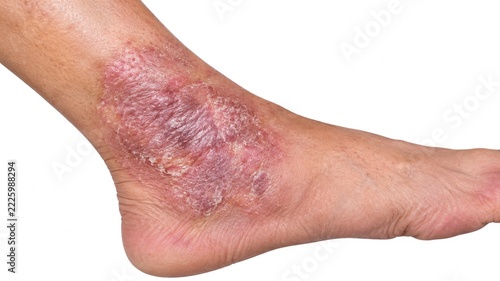 Severe red scaly eczema rash with inflamed dry skin patches on human ankle and foot isolated on white background