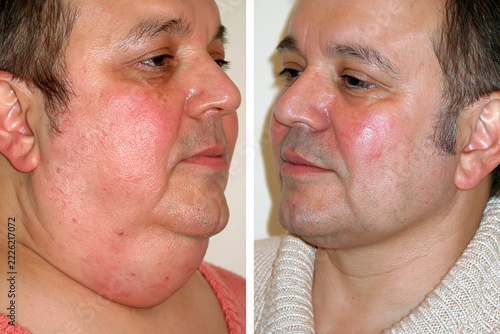 Mature man neck procedure and rosacea treatment results, reduced redness and slimmer jawline, side by side comparison.