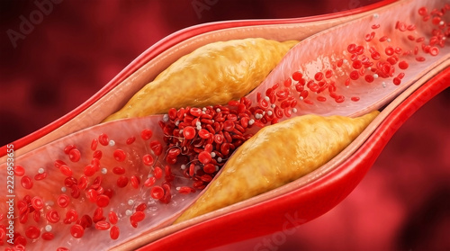Cholesterol Plaque Artery 3D Medical Illustration Showing Atherosclerosis Blockage and Red Blood Cells for Cardiology Healthcare Media Use