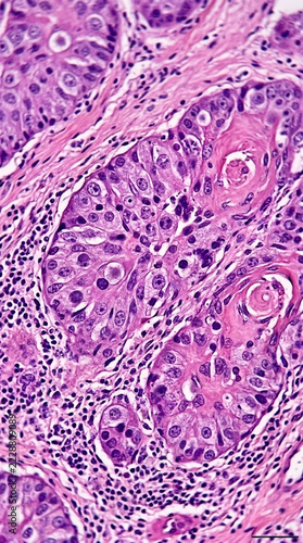 Microscopic view of abnormal cellular growth highlighting unusual cell structures and tissue morphology Cancer research concept