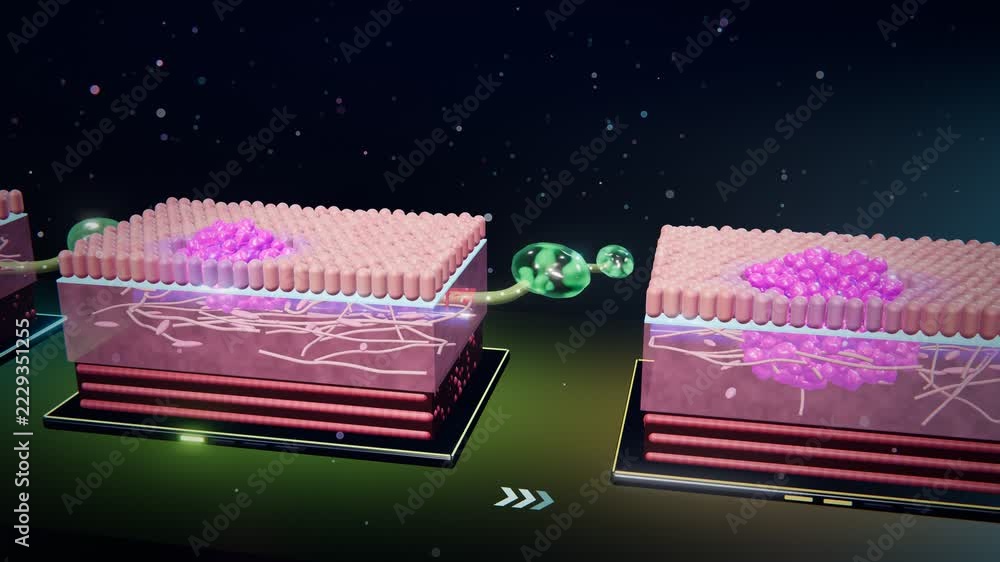 3D cancer stages diagram animation showing tumor progression from ...