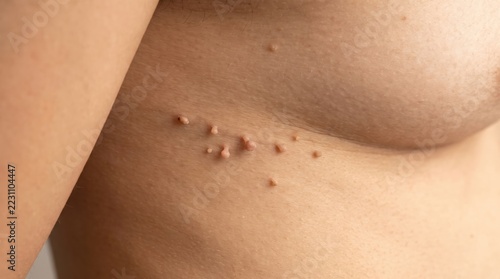 Skin tags on human chest close up view. Medical dermatology condition showing benign cutaneous growths for health education and clinical diagnosis awareness.