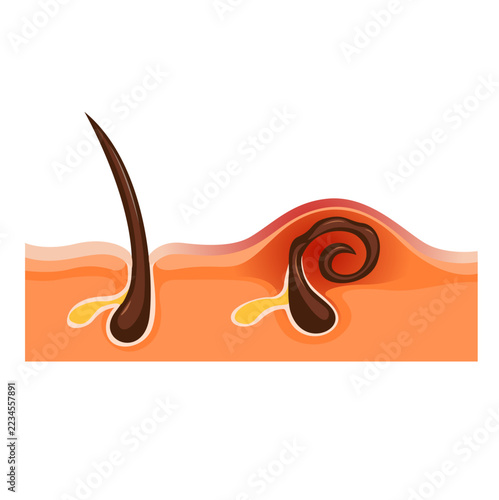 Skin Anatomy Diagram Explaining Ingrown Hair Inflammation and Folliculitis Illustration Vector