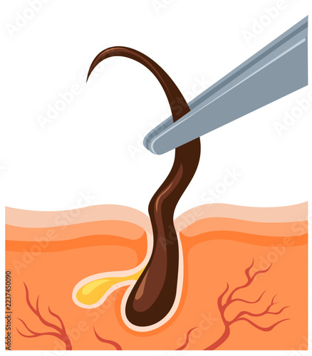 Anatomy Hair Follicle Removal from Skin using Tweezers Illustration Vector